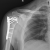 Outcomes of Internal Fixation in Proximal Humerus Head Split Fractures in Young Adults – How Often Is It Missed and Can We Really Afford to Do So