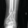 Distal Tibial Atrophic Pseudoarthrosis Treated with Vascularized Fibular Graft and Ankle Arthrodesis Nail: A Multidisciplinary Orthoplastic Case Report