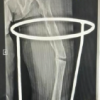 Management of a Case of Adult Mid-Shaft Femur Fracture in Osteogenesis Imperfecta by Long Proximal Femoral Nail: A Case report