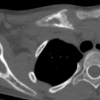 A Rare Occurrence of Chronic Recurrent Multifocal Osteomyelitis in Clavicle: Case Report