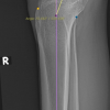 Association of Posterior Tibial Slope and Metaphysio-Diaphyseal Angle with Radiographic Severity of Knee Osteoarthritis in the Indian Population