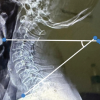 Alterartions of Cervical Lordosis in Neck Pain Patients
