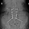Multiple Myeloma Presenting as Cauda Equina Syndrome: A Rare and Early Spinal Manifestation
