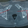 Incidence and Functional Impact of Malrotation after Intramedullary Nailing of Femoral Shaft Fractures: A Prospective Computed Tomography-based Observational Study