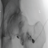 Case Report of Rapidly Destructive Osteoarthritis of the Hip following Multiple High-dose Intra-articular Steroid Injections