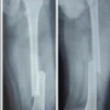 Outcome Assessment of Femoral Shaft Fractures Managed by Nailing and Derotation Plating