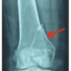 Medial Hoffa’s Fracture Treated with Subvastus Approach – Case Series