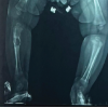 Osteofibrous Dysplasia in a 4-Month-Old: A Rare Presentation in Early Infancy