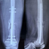 Distal Dilemma: Antegrade or Retrograde Nailing in Distal Femur Shaft Fractures