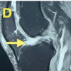 Restoring Stability – A Case of a Decade Old Triple Bucket Handle Meniscus Tear with an Anterior Cruciate Ligament Injury: Case Report