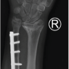 Addressing Bilateral Post-traumatic Distal Radius Growth Arrest with Positive Ulnar Variance with Acute Ulnar Shortening Osteotomy and Distal Radioulnar Joint Fixation in a 13-Year-Old Child: A Case Report
