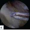 Functional Outcome of Arthroscopic Single-row Rotator Cuff Repair Using the PENN Shoulder Score – A Prospective Cohort Study