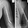 A Rare Clinical Dilemma: Humeral Shaft Fracture in a Full-Term Pregnant Patient – A Case Report with Review of Literature