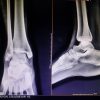 A Rare Visitor at the Ankle: Synovial Chondromatosis of the Lateral Malleolus