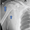 Post-Traumatic Subcutaneous Emphysema of the Upper Extremity Associated with an Open Scapular Fracture: A Case Report and Review of Literature