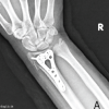Bilateral simultaneous distal radius fractures with elbow dislocations following a fall from height: A rare orthopedic quadruple injury with review of the literature