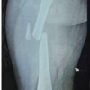 Outcome of Pediatric Femoral Shaft Fractures Treated with Titanium Elastic Nailing: A Prospective Study