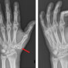 Myositis Ossificans of the Thenar Eminence mimicking a Fracture of an Accessory Trapezium: A Case Report