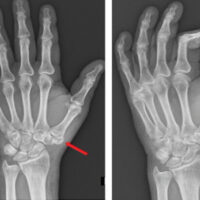 Figure 1: Anteroposterior and oblique views of the left hand showing suspicion of a fracture of an accessory trapezium (red arrow).