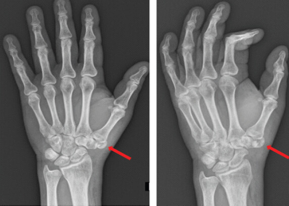 Figure 1: Anteroposterior and oblique views of the left hand showing suspicion of a fracture of an accessory trapezium (red arrow).