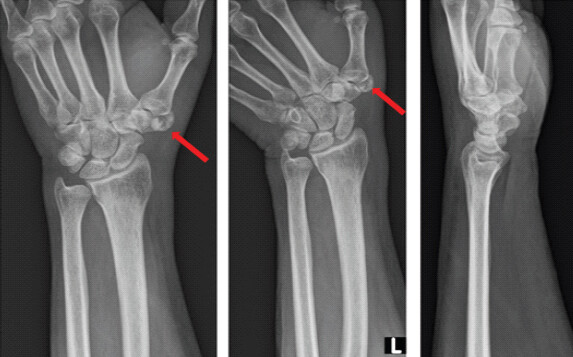 Figure 2: Anteroposterior, lateral and scaphoid views of the left wrist showing suspicion of a fracture of an accessory trapezium (red arrow).