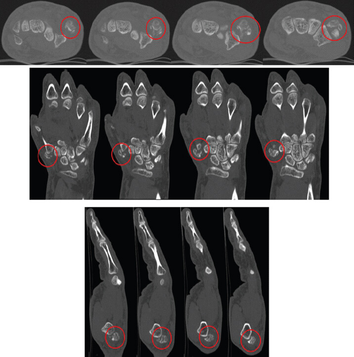 Figure 3: Axial, coronal and sagittal computed tomography reformats of the left hand showing fragmentation and cortical lucencies mimicking a fracture an accessory trapezium (red circle).