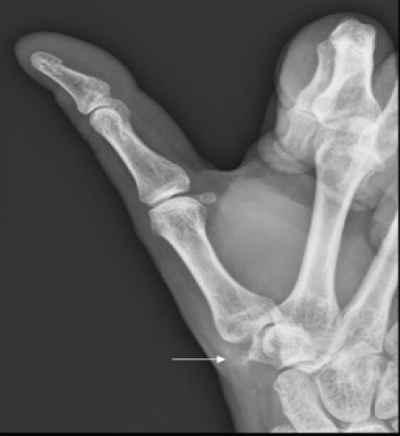 Figure 4: X-ray of the left thumb obtained 6 weeks later showing almost complete resolution the ossific densities previously seen. Minimal calcific density is present (thin arrow).
