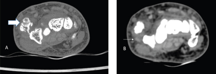Figure 5: Axial computed tomography scan of the wrist (a: Bone window; b: Soft-tissue window) showing multiple (thick arrow) well-corticated bony structures with a mature bony matrix in the soft-tissues medial to the first extensor group (thin arrow).