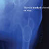 Clinicoradiological Outcomes after Percutaneous Radiofrequency Ablation of Benign Bone Tumors: A Prospective Observational Study