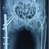 The Impact of Medial Cortical Reduction on the Outcomes of Fixation in Unstable Intertrochanteric Fractures
