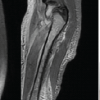 Acute Osteomyelitis with Deep Vein Thrombosis in Children: A Case Series of MRSA-Associated Infections