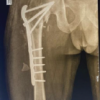 Total Hip Arthroplasty in Failed Hip Fractures, a Challenge with Fruitful Outcome: A Case Series