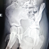 Isolated Osteochondromas of the Inner and Outer Tables of the Ilium: A Report of two Rare Cases