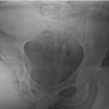 “No Traction” Technique: A Novel, Simple, Easy, and Ergonomic Manoeuvre to Reduce Posterior Dislocation of the Hip Joint – A Case Report