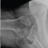 Anterior Latissimus Dorsi and Teres Major Tendon Transfer with Total Shoulder Arthroplasty in the Setting of Subscapularis Insufficiency: A Case Report