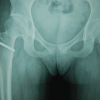 Primary Synovial Chondromatosis of the Hip Joint: A Case Report