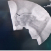 Retrieval Technique of a Broken Guidewire During Core Decompression: Bailout Options – A Case Report