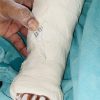 Easy Cast Removal in Idiopathic Congenital Talipes Equinovarus: A Study on Modified Ponseti Technique using an Interposed Polythene Sheet