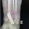 Anterior Tibial Artery Pseudoaneurysm Following Arthroscopic Ankle Arthrodesis: A Case Report