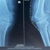 Surgical Management of Knee Synovial Chondromatosis through Posterior Open Synovectomy: A Unique Case Report