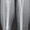 Fixation of Distal Fibula Fractures Associated with Extra-articular Distal One-third Tibia Fractures – Is It Necessary?