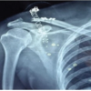 Management of a Failed Infected Acromio-Clavicular Joint Fixation with Chronic Instability using Anatomical Hybrid Reconstruction Technique: A Case Report