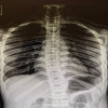 Spinal Stenosis in Achondroplasia – A Case Report and Review of the Literature
