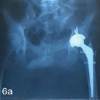 Total Hip Arthroplasty for Neglected Hip Dislocation – Surgical Technique and Results