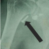 Eden-Hybinette Procedure as Salvage Treatment for Failed Latarjet Surgery: A Case Report
