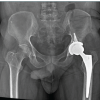 Fungal Infection of Native Hip Joint Presenting as Secondary Arthritis in 52-Year-Old Male – A Rare Case Report