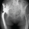 Treatment of Hip Osteoarthritis with Severe Acetabular Bone Defects by Total Hip Arthroplasty Using the Restoration GAP II Reinforcement Ring: A Case Report
