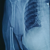 Atypical Transverse Midshaft Humerus Fracture in an Octogenarian: Surgical Nuances and Functional Outcome Following Locked Intramedullary Nailing