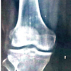 Single-Stage Management of Anterior Cruciate Ligament Tear with Dual Menisci Bony Root Avulsion: A Rare Case Report and Review of Literature
