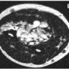 Zoledronic Acid in the Management of Melorheostosis of Radius and Ulna – A Rare Case Report with Literature Review